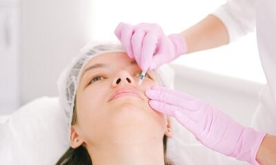 nasal fold filler